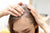 alopecia-areata-perdita-capelli